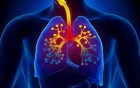 Akute und chronische Bronchitis